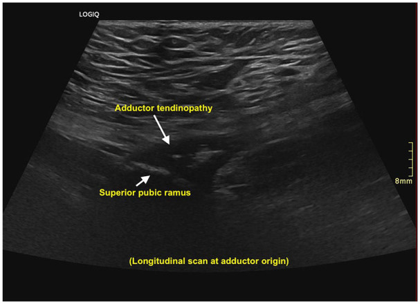 Hernia 2 Tempo Formacion Ecografia 2.jpg